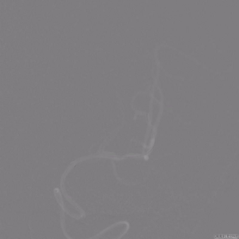 导丝怎么扩【载药时代 球扩天下】NOVA DES®颅内药物洗脱支架在颅内富穿支区域使用体会二例！_https://www.jmylbn.com_新闻资讯_第17张