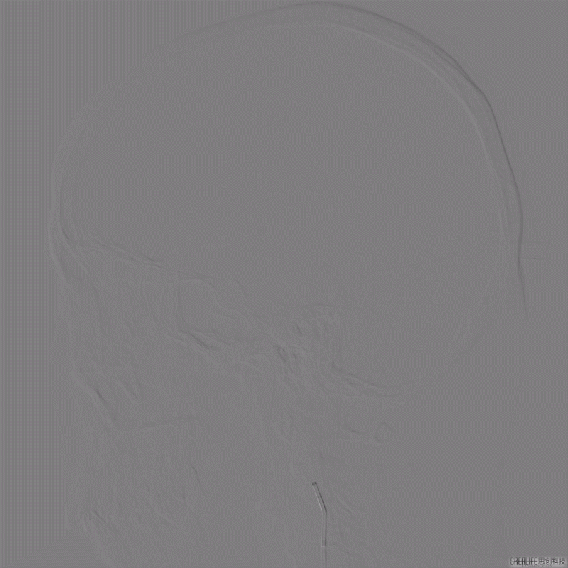 导丝怎么扩【载药时代 球扩天下】NOVA DES®颅内药物洗脱支架在颅内富穿支区域使用体会二例！_https://www.jmylbn.com_新闻资讯_第5张