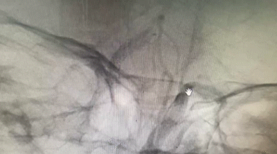 导丝怎么扩【载药时代 球扩天下】NOVA DES®颅内药物洗脱支架在颅内富穿支区域使用体会二例！_https://www.jmylbn.com_新闻资讯_第32张