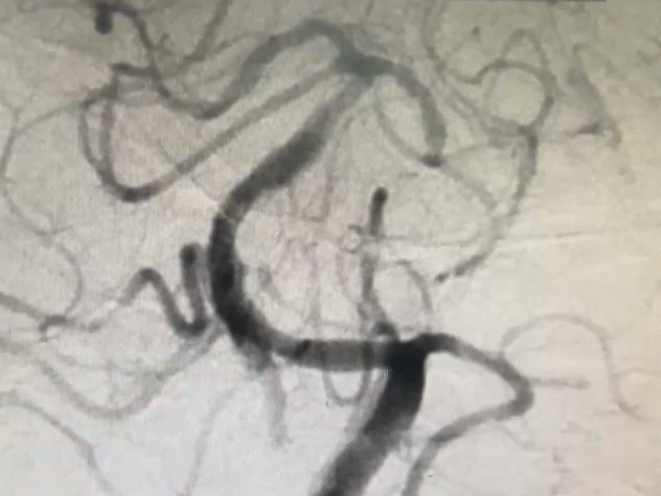 导丝怎么扩【载药时代 球扩天下】NOVA DES®颅内药物洗脱支架在颅内富穿支区域使用体会二例！_https://www.jmylbn.com_新闻资讯_第33张
