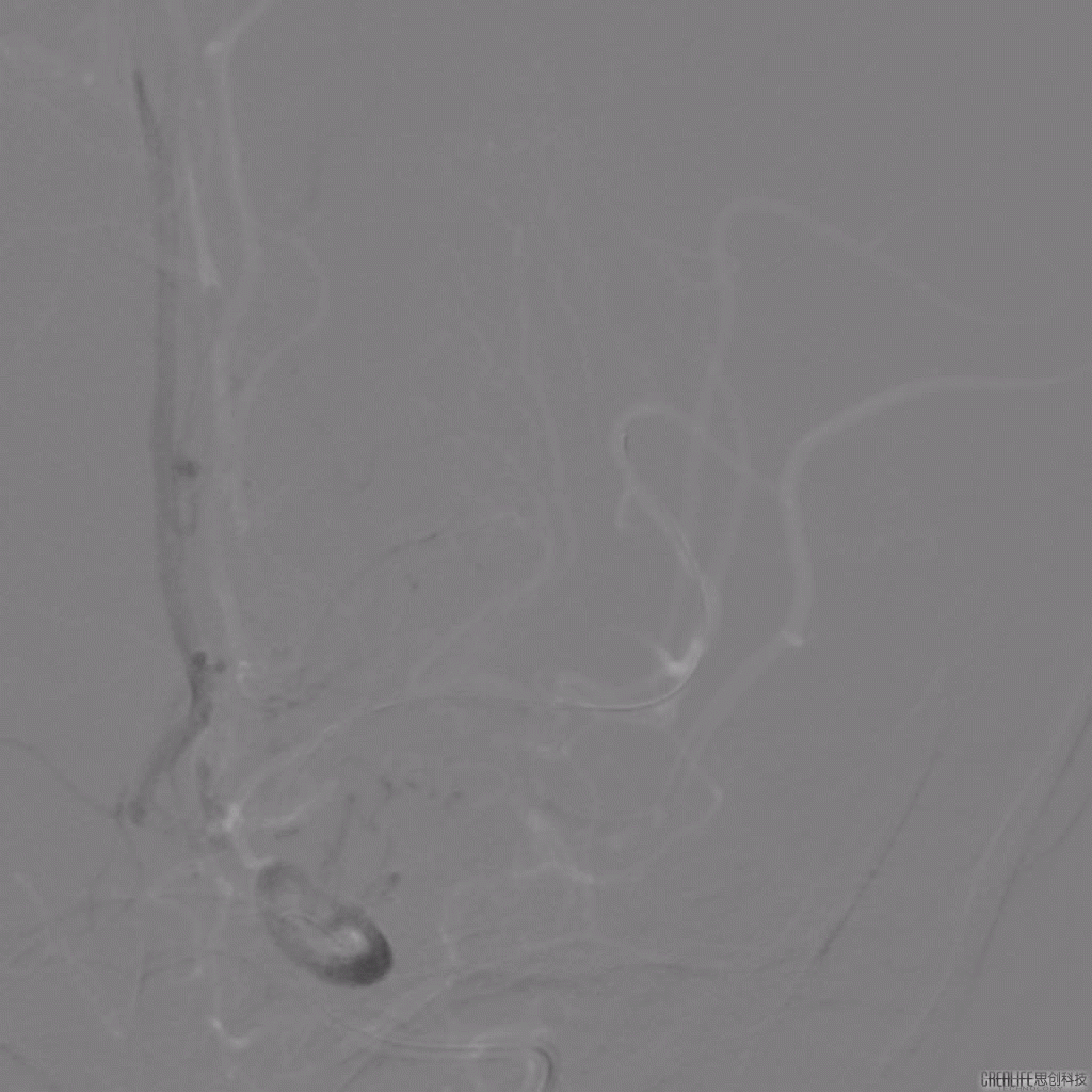 导丝怎么扩【载药时代 球扩天下】NOVA DES®颅内药物洗脱支架在颅内富穿支区域使用体会二例！_https://www.jmylbn.com_新闻资讯_第19张