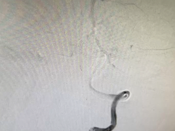 导丝怎么扩【载药时代 球扩天下】NOVA DES®颅内药物洗脱支架在颅内富穿支区域使用体会二例！_https://www.jmylbn.com_新闻资讯_第34张