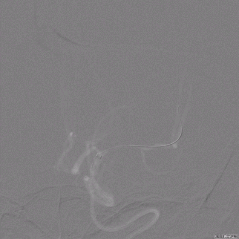 导丝怎么扩【载药时代 球扩天下】NOVA DES®颅内药物洗脱支架在颅内富穿支区域使用体会二例！_https://www.jmylbn.com_新闻资讯_第15张