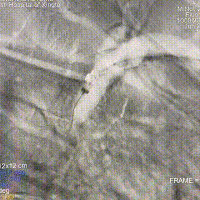 动脉长鞘怎么置入【有励可说】Locaste 088长鞘经左桡治疗左侧锁骨下动脉狭窄一例_https://www.jmylbn.com_新闻资讯_第10张