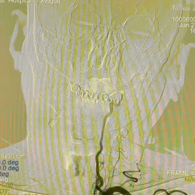 动脉长鞘怎么置入【有励可说】Locaste 088长鞘经左桡治疗左侧锁骨下动脉狭窄一例_https://www.jmylbn.com_新闻资讯_第16张