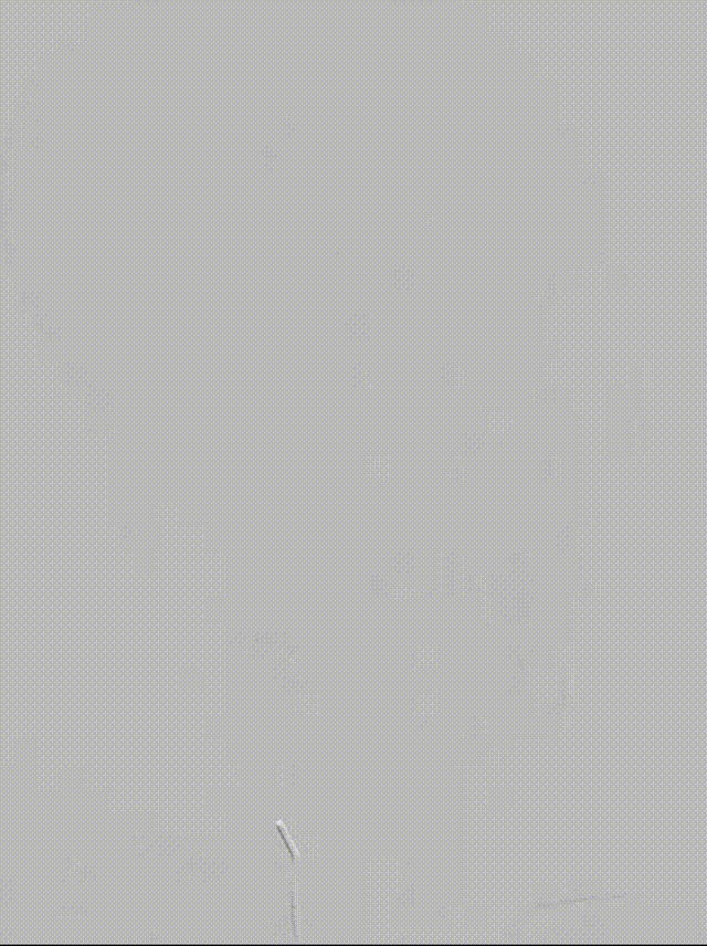 什么叫桡鞘【例久弥新】寻道于桡——瑞康通5.5F Introsky X导管鞘经桡入路治疗颈动脉重度狭窄一例_https://www.jmylbn.com_新闻资讯_第17张