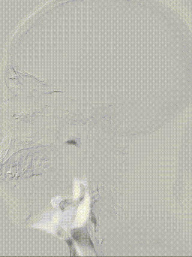 什么叫桡鞘【例久弥新】寻道于桡——瑞康通5.5F Introsky X导管鞘经桡入路治疗颈动脉重度狭窄一例_https://www.jmylbn.com_新闻资讯_第18张