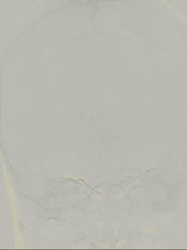 什么叫桡鞘【例久弥新】寻道于桡——瑞康通5.5F Introsky X导管鞘经桡入路治疗颈动脉重度狭窄一例_https://www.jmylbn.com_新闻资讯_第16张