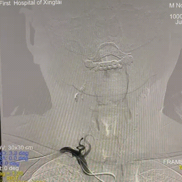 动脉长鞘怎么置入【有励可说】Locaste 088长鞘经左桡治疗左侧锁骨下动脉狭窄一例_https://www.jmylbn.com_新闻资讯_第7张