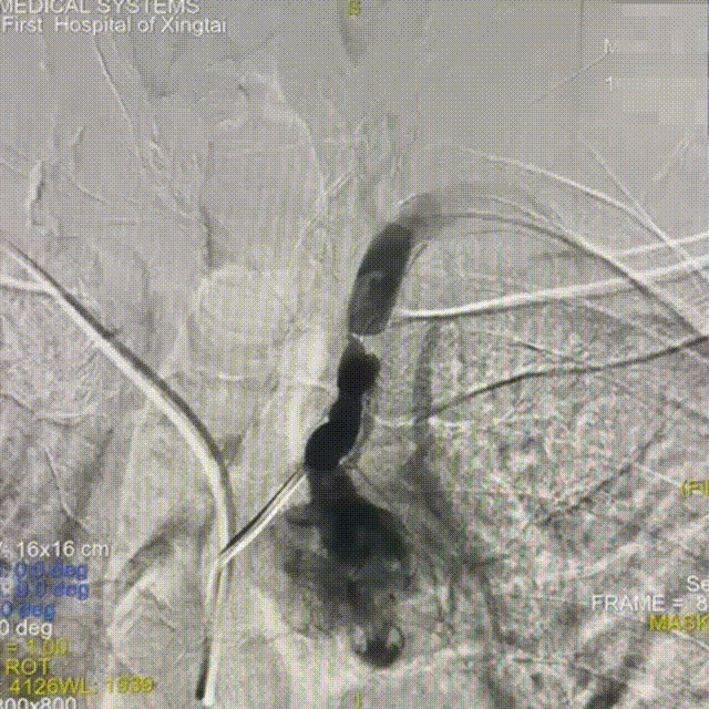 动脉长鞘怎么置入【有励可说】Locaste 088长鞘经左桡治疗左侧锁骨下动脉狭窄一例_https://www.jmylbn.com_新闻资讯_第5张