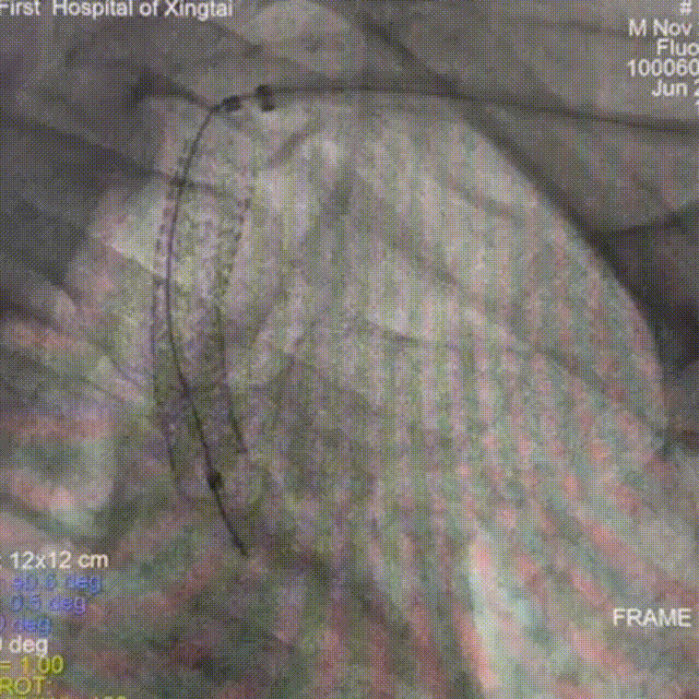 动脉长鞘怎么置入【有励可说】Locaste 088长鞘经左桡治疗左侧锁骨下动脉狭窄一例_https://www.jmylbn.com_新闻资讯_第14张