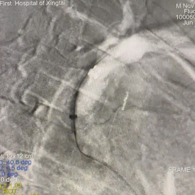 动脉长鞘怎么置入【有励可说】Locaste 088长鞘经左桡治疗左侧锁骨下动脉狭窄一例_https://www.jmylbn.com_新闻资讯_第11张