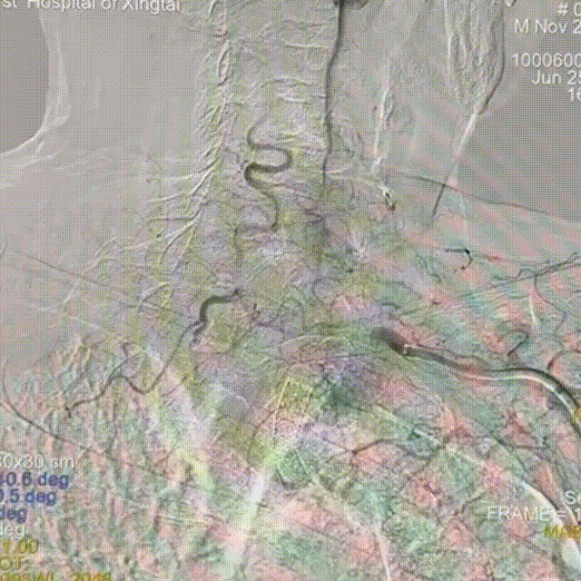 动脉长鞘怎么置入【有励可说】Locaste 088长鞘经左桡治疗左侧锁骨下动脉狭窄一例_https://www.jmylbn.com_新闻资讯_第15张