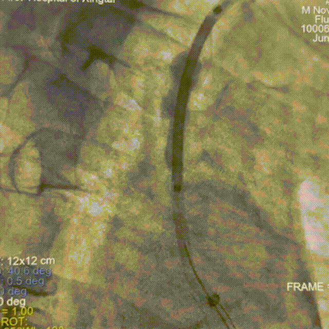 动脉长鞘怎么置入【有励可说】Locaste 088长鞘经左桡治疗左侧锁骨下动脉狭窄一例_https://www.jmylbn.com_新闻资讯_第12张