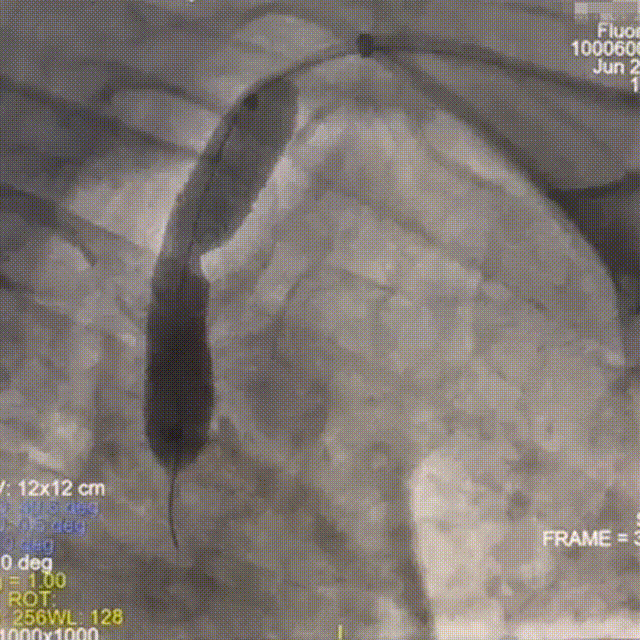 动脉长鞘怎么置入【有励可说】Locaste 088长鞘经左桡治疗左侧锁骨下动脉狭窄一例_https://www.jmylbn.com_新闻资讯_第13张