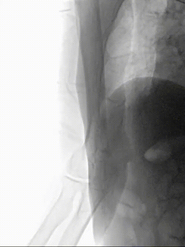 什么叫桡鞘【例久弥新】寻道于桡——瑞康通5.5F Introsky X导管鞘经桡入路治疗颈动脉重度狭窄一例_https://www.jmylbn.com_新闻资讯_第15张