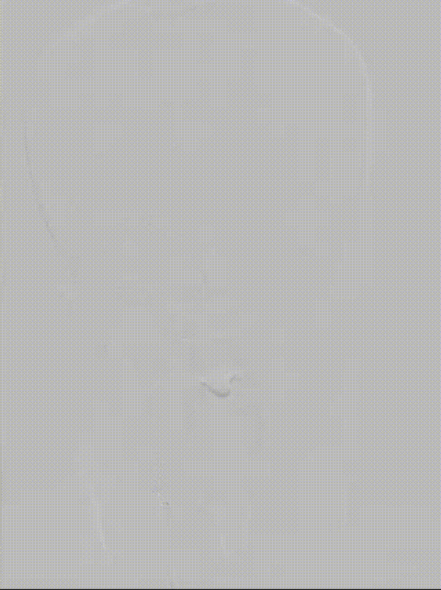 什么叫桡鞘【例久弥新】寻道于桡——瑞康通5.5F Introsky X导管鞘经桡入路治疗颈动脉重度狭窄一例_https://www.jmylbn.com_新闻资讯_第24张