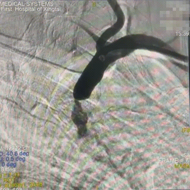 动脉长鞘怎么置入【有励可说】Locaste 088长鞘经左桡治疗左侧锁骨下动脉狭窄一例_https://www.jmylbn.com_新闻资讯_第9张