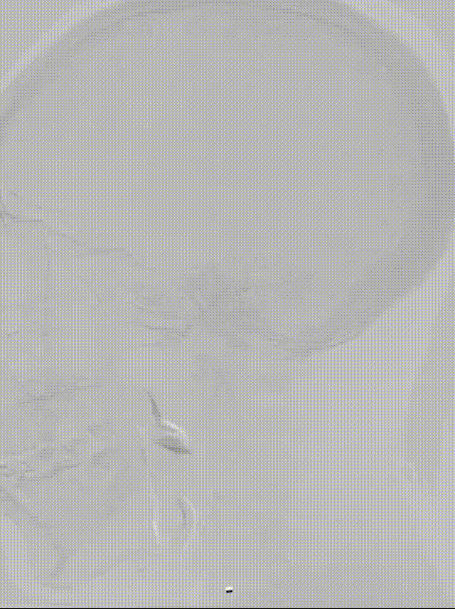 什么叫桡鞘【例久弥新】寻道于桡——瑞康通5.5F Introsky X导管鞘经桡入路治疗颈动脉重度狭窄一例_https://www.jmylbn.com_新闻资讯_第25张