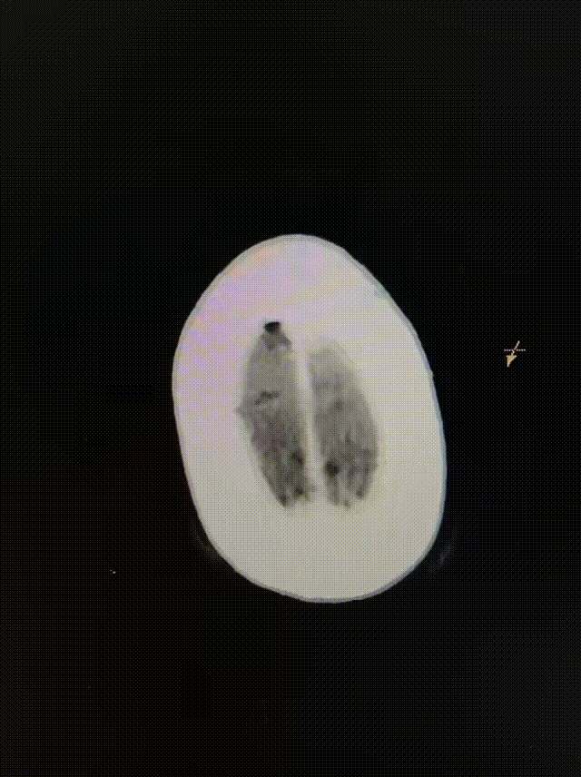 动脉长鞘怎么置入健谈•一鞘双能｜温昌明教授团队：BMAX088球囊长鞘治疗左侧大脑中动脉闭塞一例_https://www.jmylbn.com_新闻资讯_第14张