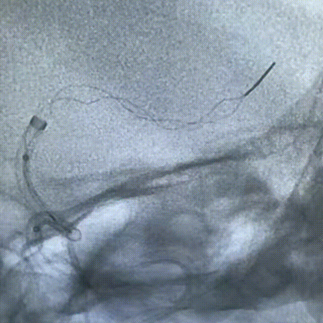 动脉长鞘怎么置入健谈•一鞘双能｜温昌明教授团队：BMAX088球囊长鞘治疗左侧大脑中动脉闭塞一例_https://www.jmylbn.com_新闻资讯_第9张