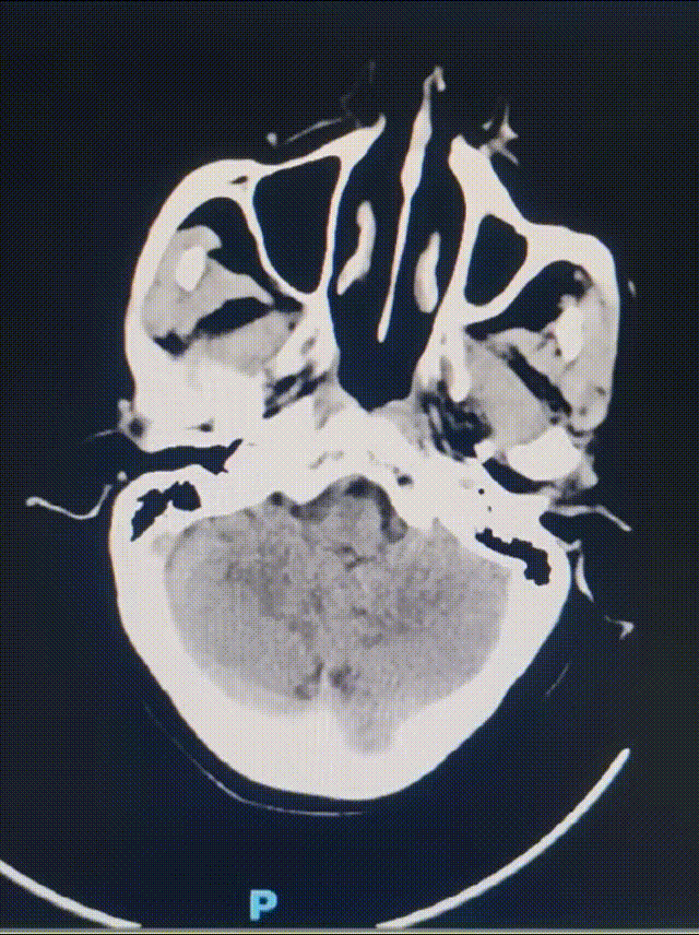 动脉长鞘怎么置入健谈•一鞘双能｜温昌明教授团队：BMAX088球囊长鞘治疗左侧大脑中动脉闭塞一例_https://www.jmylbn.com_新闻资讯_第3张