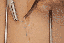 医疗缝线怎么做动图+视频，详解常见手术切口缝合技术_https://www.jmylbn.com_新闻资讯_第17张