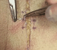 医疗缝线怎么做动图+视频，详解常见手术切口缝合技术_https://www.jmylbn.com_新闻资讯_第29张