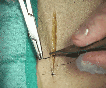 医疗缝线怎么做动图+视频，详解常见手术切口缝合技术_https://www.jmylbn.com_新闻资讯_第13张