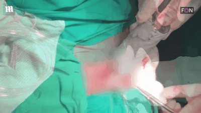 烧伤敷料怎么用图解舌尖上的医学敷料：用罗非鱼皮治疗 II 度烧伤，还能重塑阴道？_https://www.jmylbn.com_新闻资讯_第9张