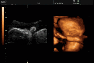 汕头彩超怎么样四维彩超啥时候预约？它检查什么？看了这篇全明白！『汕头妇产科医院』_https://www.jmylbn.com_新闻资讯_第5张