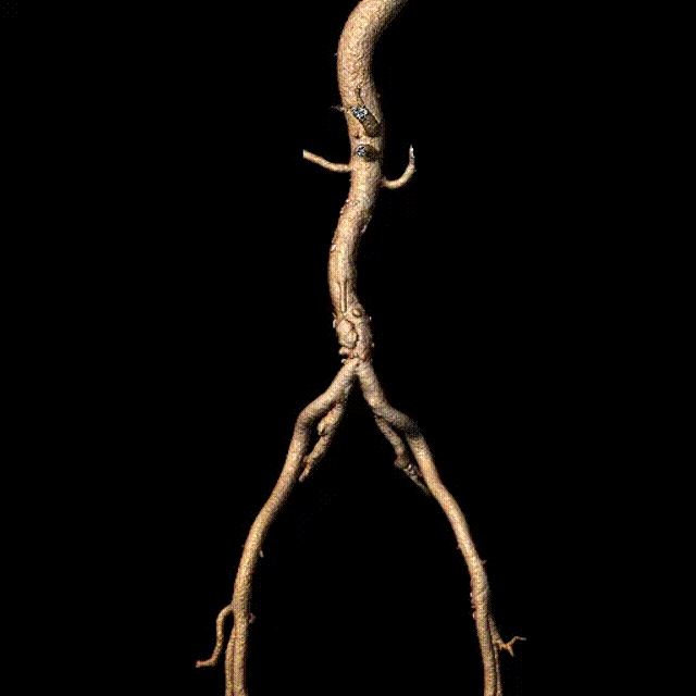 单猪尾支架怎么放【腹具匠新】吴华平教授团队：ENDURANT IIs 分叉支架开窗束径保留 IMA 治疗腹主动脉穿透性溃疡_https://www.jmylbn.com_新闻资讯_第19张