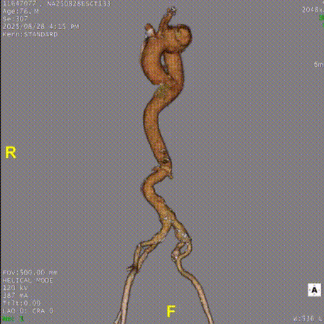 gore医疗怎么样「胸有乾坤」千钧一发 转危为安——Gore TBE治疗急诊破裂TAA一例_https://www.jmylbn.com_新闻资讯_第9张
