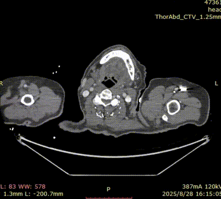 gore医疗怎么样「胸有乾坤」千钧一发 转危为安——Gore TBE治疗急诊破裂TAA一例_https://www.jmylbn.com_新闻资讯_第8张