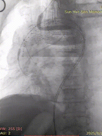 gore医疗怎么样「胸有乾坤」千钧一发 转危为安——Gore TBE治疗急诊破裂TAA一例_https://www.jmylbn.com_新闻资讯_第18张