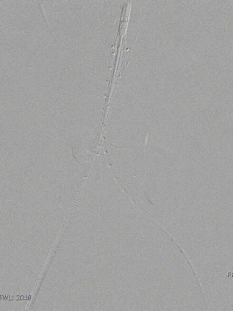 单猪尾支架怎么放【腹具匠新】吴华平教授团队：ENDURANT IIs 分叉支架开窗束径保留 IMA 治疗腹主动脉穿透性溃疡_https://www.jmylbn.com_新闻资讯_第31张