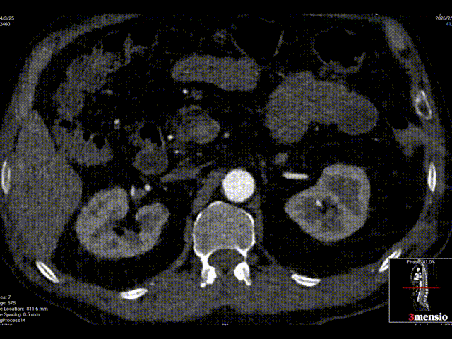 单猪尾支架怎么放【腹具匠新】吴华平教授团队：ENDURANT IIs 分叉支架开窗束径保留 IMA 治疗腹主动脉穿透性溃疡_https://www.jmylbn.com_新闻资讯_第18张