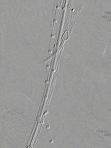 单猪尾支架怎么放【腹具匠新】吴华平教授团队：ENDURANT IIs 分叉支架开窗束径保留 IMA 治疗腹主动脉穿透性溃疡_https://www.jmylbn.com_新闻资讯_第30张