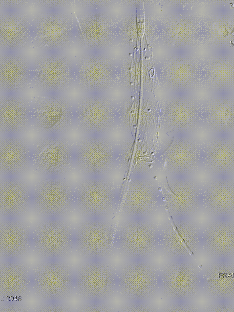 单猪尾支架怎么放【腹具匠新】吴华平教授团队：ENDURANT IIs 分叉支架开窗束径保留 IMA 治疗腹主动脉穿透性溃疡_https://www.jmylbn.com_新闻资讯_第32张