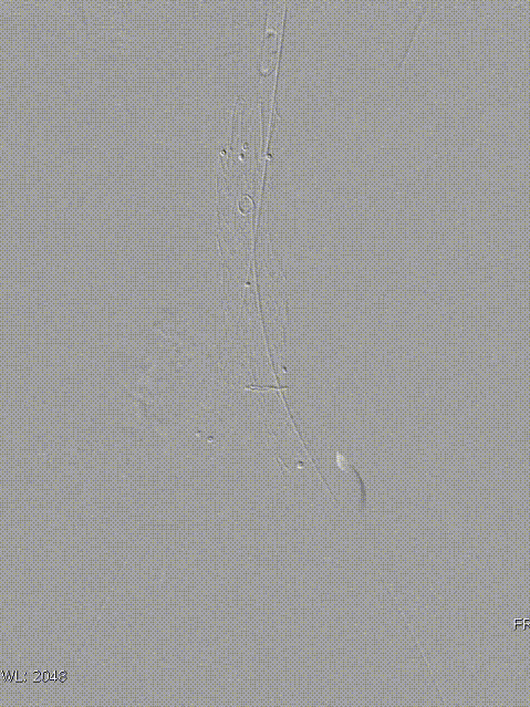 单猪尾支架怎么放【腹具匠新】吴华平教授团队：ENDURANT IIs 分叉支架开窗束径保留 IMA 治疗腹主动脉穿透性溃疡_https://www.jmylbn.com_新闻资讯_第33张