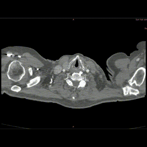 gore医疗怎么样「胸有乾坤」千钧一发 转危为安——Gore TBE治疗急诊破裂TAA一例_https://www.jmylbn.com_新闻资讯_第22张