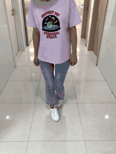 足尖着地,步态不稳,又称交叉步或剪刀步是痉挛型脑性瘫痪的典型步态