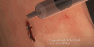 怎么买医用胶水科普｜你听说过医用胶水吗？_https://www.jmylbn.com_新闻资讯_第7张