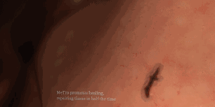 怎么买医用胶水科普｜你听说过医用胶水吗？_https://www.jmylbn.com_新闻资讯_第8张