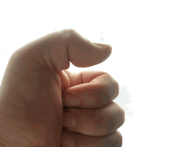 针刀松解治疗狭窄性腱鞘炎 让点赞随心所欲