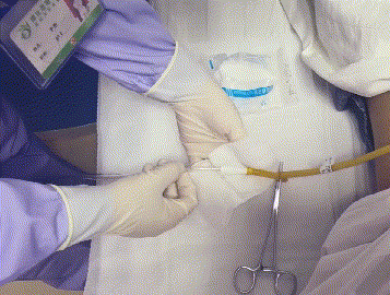 为什么要引流尿袋留置尿管护理必须掌握的操作要点——高清动图操作教学_https://www.jmylbn.com_新闻资讯_第9张