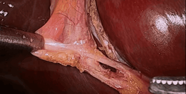 【腹腔镜篇】胆囊切除关键解剖结构