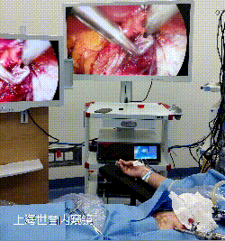 疝气补片怎么固定【4K腹腔镜篇】疝气修补手术_https://www.jmylbn.com_新闻资讯_第2张