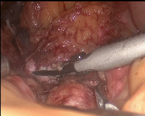 【腹腔镜篇】静脉意外出血的处置应对 【腹腔镜篇】静脉意外出血的处置应对