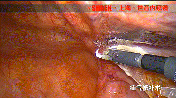 疝气补片怎么固定【腹腔镜篇】疝修补术——疝气的最佳手术方式_https://www.jmylbn.com_新闻资讯_第6张